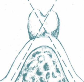 (그림 58) 교두가 있는 인공치