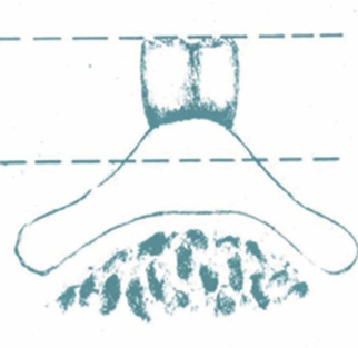 △  (그림 58) B. 교두가 없는 인공치