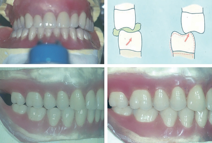 ▷  (그림 60) Incursion의 개념. “기능 운동시 작업측 교두간의 Cusp to embrasure의 접촉에서 cusp to fossa의 관계인 Centric 상태로 이동한다”는 개념이다.