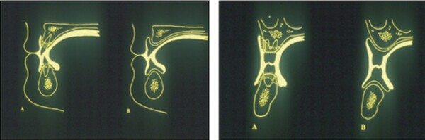 △  (그림 61) 상하악치아의 해부학적인 위치. 1. 상악 전치부는 Lip support, 2. 하악 전치부는 lower lip(1/3 labial surface), 3. 상악 구치부는 buccal overjet, 4. 하악 구치부는 tongue & cheek의 neutral zone에 위치하며 주변 연조직을 support한다.