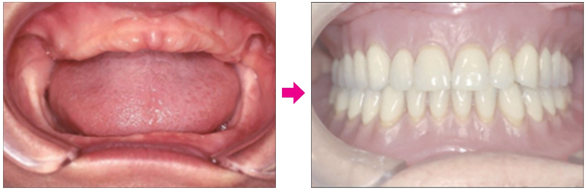 △ (그림 62) 하악 완전 무치악 상태와 Wax denture의 시적 모습.