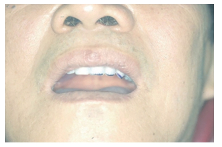 (그림 64) 상악치아의 교합평면 설정이 기울어져 있 다면 magic pen 으로 칠해주어 기공실에서 수정 하는데 도움을 줄 수 있다.