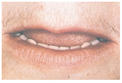 △  (그림 65) Rest 상태에서 하악 전치부 incisal 1/3 정도가 보이는 것이 일반적이다.