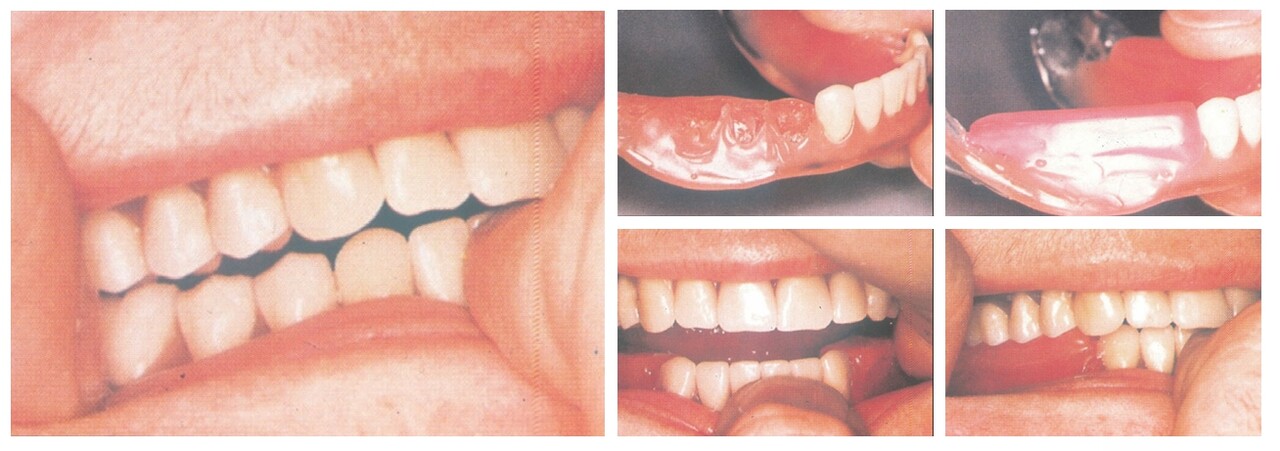 △  (그림 67) 좌측처럼 wax denture의 centric jaw relation이 error가 있을 경우에는 하악 구치부의 인공치아를 제거하고 다시 base plate wax를 올려준 후에 연화시켜 Jaw relation record 채득한다.