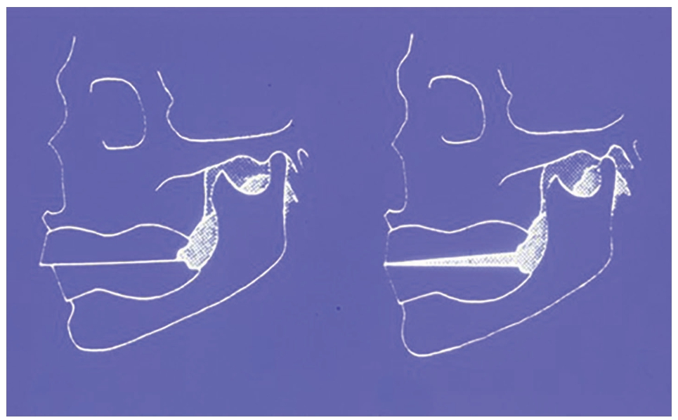 △ (그림 68) 전방유도기록 채득하여 교합기의 하악과두의 전방유도각을 조절하는 모식도 조절된 교합기 위에서 balanced occlusion concept에 맞게 도치배열을 수정한다.