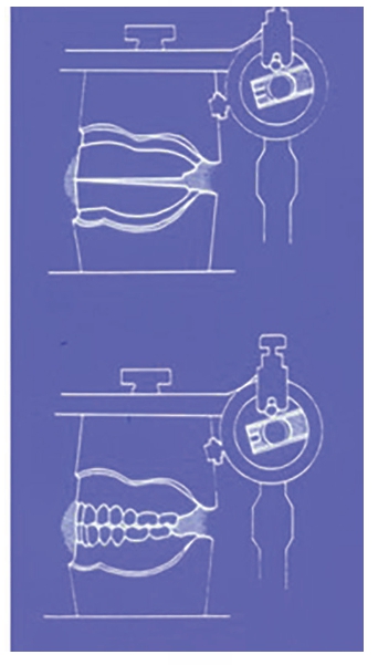 △ 하악 완전 무치악 상태와 Wax denture의 시적 모습.