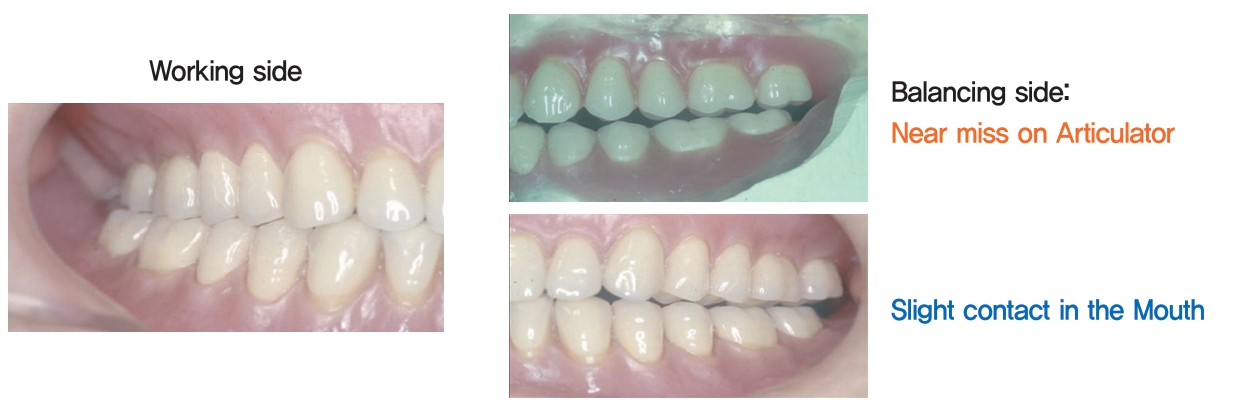 △ (그림 70) 인공치아 배열이 완성된 모습. 교합기상에서는 buccal cusp to embrasure가 되도록 해주고 비작업측에서는 아주 약하게 닿거나 0.5mm 정도 띄워주면 저작시에 구강 내에서는 비작업측이 premature contact이 되지 않고 slight하게 접촉되어 의치가 탈락되지 않도록 해 준다.