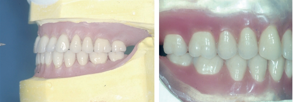 (그림 72) Wax denture의 순측면 및 협측, 치근의 풍융부, 치은연 및 치은유두 및 치은의 완성된 모습