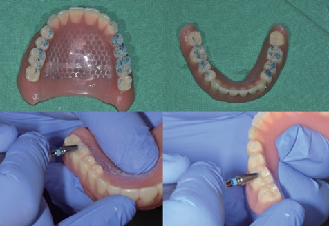 △ (그림 81) 교합지를 이용하여 Premature contact을 check 한 후 교합조정을 해주어 야 한다.