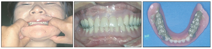 △ (그림 82) 좌) Clinical remounting을 위하여 소구치와 대구치 상방의 Alu wax에 의해 jaw relation record를 채득하는 모습, 중) 상하악 소구치와 대구치 상방의 Alu wax, 우) 채득된 중심위 Alu Wax record의 모습.