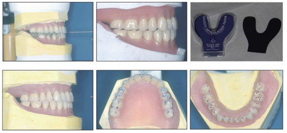 (그림 82) 상) 교합기 위에서 mounting된 모습 상·하악 치아 간에 premature conta ct 및 space를 볼수 있다. 하) Carbon paper 등을 이용하여 교 합조정을 하여 Jaw relation error를 수정하는 모습.