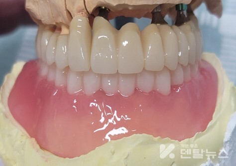 A기공소 ‘FLEXIBLE’ 레진 출력물