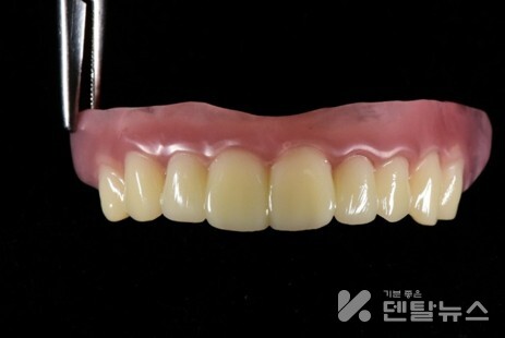 B기공소 ‘FLEXIBLE’ 레진 출력물