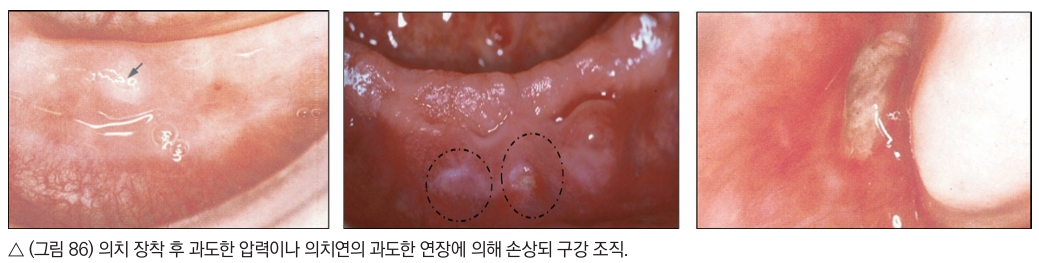 △  (그림 86) 의치 장착 후 과도한 압력이나 의치연의 과도한 연장에 의해 손상되 구강 조직