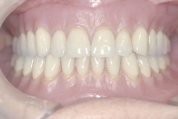 △ (그림 87) Closed mouth technique에 의한 Direct Relining 및 Indirect Relining 의한 의치의 첨상.