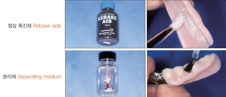 △ (그림 89) 조직면과 변연부위에 Rebase aid를 발라주고, 바깥 부분에는 resin 분리제 나 vaseline을 발라주어 relining resin이 구강 내에서 일시 경화된 후에 잉여 resin을 제거하기 쉽도록 해준다.