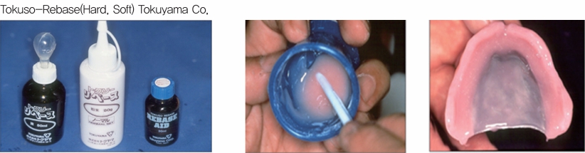 △ (그림 90) 첨상레진의 viscosity가 light body VPS와 비슷한 점도를 가질 때에 의치의 내면에 올려준다.