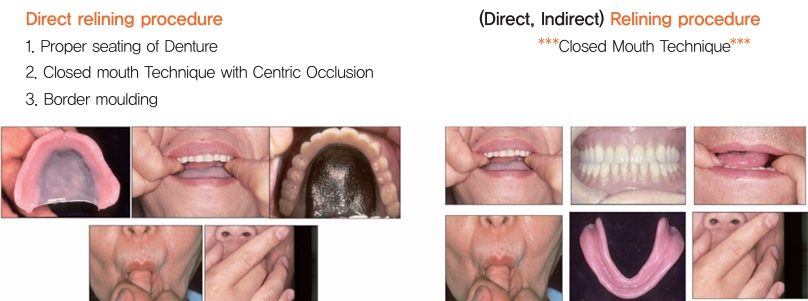 △ (그림 91) 구강 내에 의치를 삽입하여 의치의 최종인상을 채득할 때와 같이 border moulding을 시행하고 환자에게 가볍게 다물도 록 폐구시킨 상태에서 첨상레진이 경화되도록 기다린다.