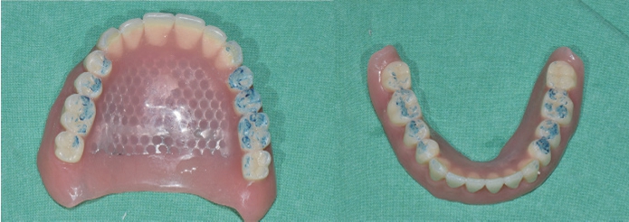 △ (그림 93) 의치의 첨상이 완료된 후에는 구강 내에서 교합을 점검하여야 하고, 약간의 교합조정이 필수적으로 요구된다.