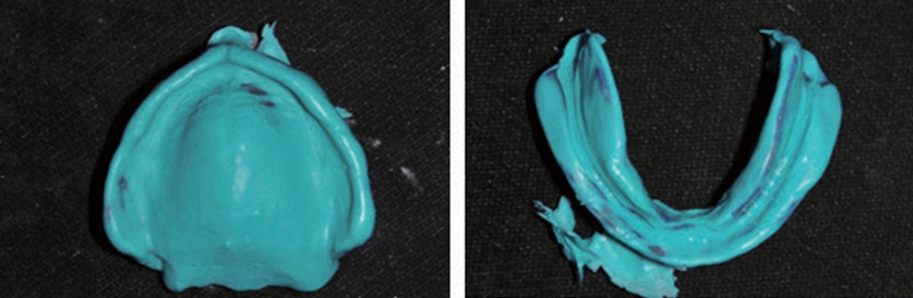 △  (그림 94) 상하악 의치의 Indirect Relining을 위하여 Light body VPS를 아용하여 border moulding 후 Closed mouth technique에 의해서 impression을 뜬다.