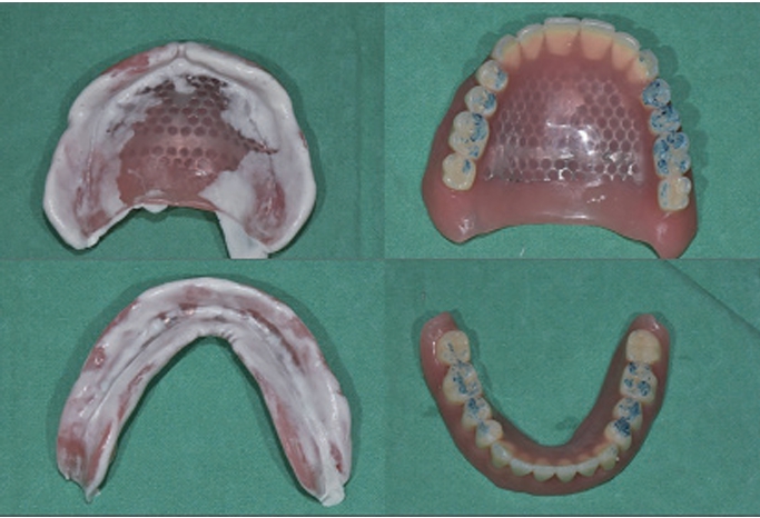 △  (그림 95) 간접법에 의해 첨상된 의치는 Fit checker 등과 같은 재료를 이용한 조직면의 평가와 교합조정과정을 거쳐야 한다.