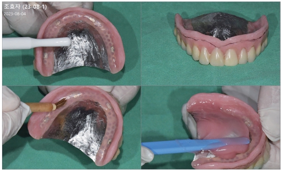 △ (그림 97) (상) 의치의 금속 면에 Universal Bond를 바른 후에 레진 부위에 Rebase adhesive를 발라준다. 첨상 레진은 혼합비율에 맞도록 섞어주고, 기포가 생기지 않도록 잘 혼합한 후 흐름성이 좋을 때 우선 의상 내면에 한번 얇게 coating해 주어 첨상 레진의 화학적 결합이 잘 되도록 해 준다.