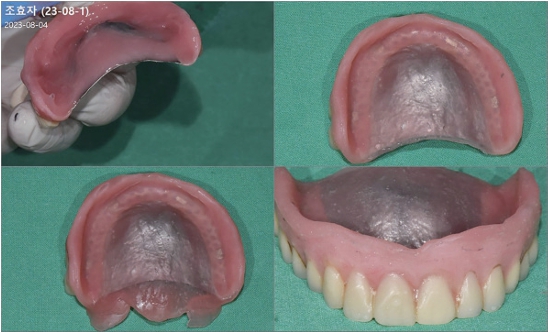 △  (그림 97) (하) light body VPS 정도의 viscosity가 되었을때 의치상에 추가의 첨상레진을 충분히 발라준 후 구강 내에 끼워준 후 동일한 방법으로 Relining을 마무리한다.