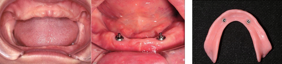 △  (그림 1) McGill Consensus Statement. 상하악 무치악 환자의 첫번째 치료계획은 상악은 총의치, 하악은 2개의 임플란트를 식립 후 임플란트 틀니(Implant overdenture)가 되어야한다.