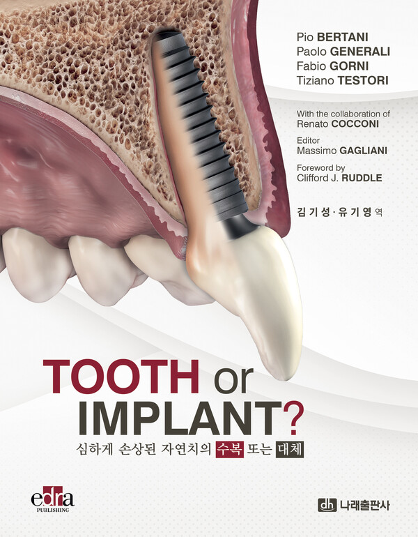 “TOOTH or IMPLANT?”는 단순히 치아를 살릴 것인가 뽑을 것인지의 선택지를 넘어서, 임상의가 환자와 함께 최선의 선택을 내릴 수 있도록 돕는 임상 동반서이자 판단 기준의 교과서다. 덴탈뉴스