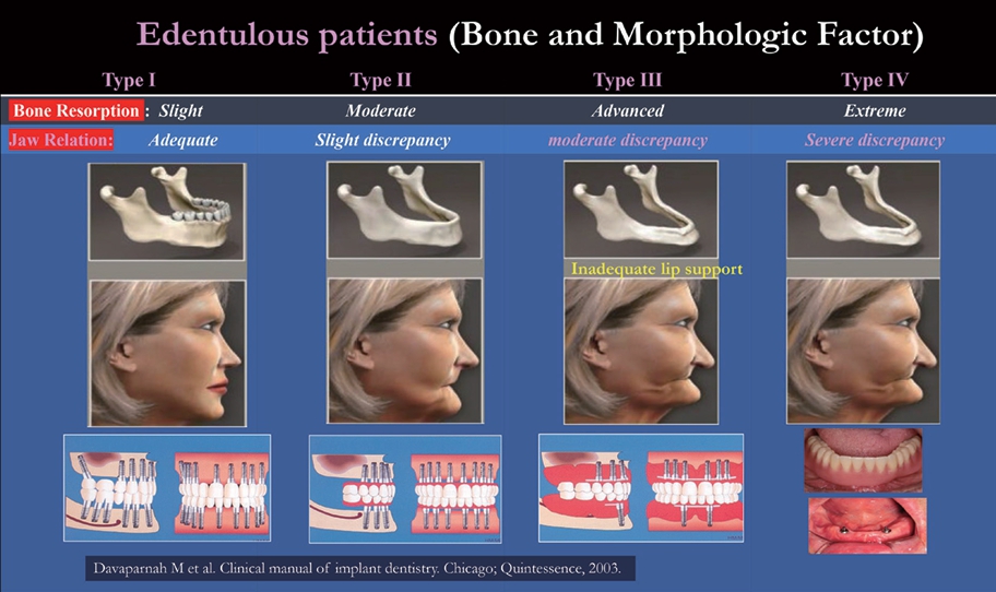 △ (그림 3) 치조골 흡수와 악간관계의 부조화 정도에 따라 4가지 보철수복방법이 추천된다. 조건이 좋을수록 고정성 보철물을, 조건이 나쁠수록 가철성 보철물을 고려하게 된다.