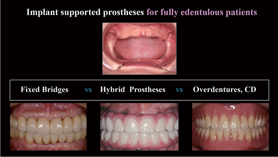 △  (그림 4) 무치악 환자의 일반적인 임플란트 보철물은 3가지로 분류한다.