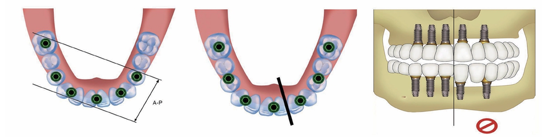 △ (그림 6) 치조골 흡수정도에 따라 Segmented bridge를 위해 넓게 분포되도록 임플란트를 식립하거나, 치조골 흡수가 심한 경우에는 이공 전방 부에 국한하여 식립하게 된다.