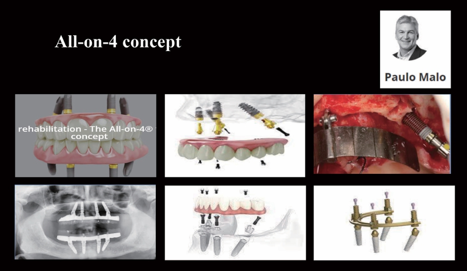 (그림 7) Paulo Molo가 소개한 All-on-4 Concept.