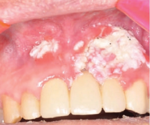 ▲ 윗잇몸에 발생한 구강암(상피종; carcinoma) 덴탈뉴스