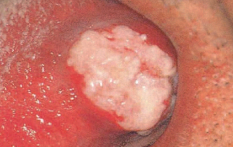 ▲ 혀에 발생한 설암(육아종; sarcoma) 덴탈뉴스