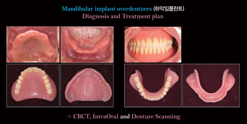 △ (그림 8) CBCT 촬영 및 Scanning 하기 전에 complete denture 혹은 임시의치가 제작되어 있어야 한다. 덴탈뉴스