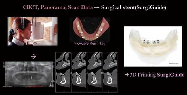 △ (그림 9) Denture에 Flowabe resin tag를 붙여준 후 CBCT 촬영 및 Scanning후 중첨시 활용하고 분석하여 임플란 트 식립을 위한 Surgi Guide를 제작하게 된다. 덴탈뉴스
