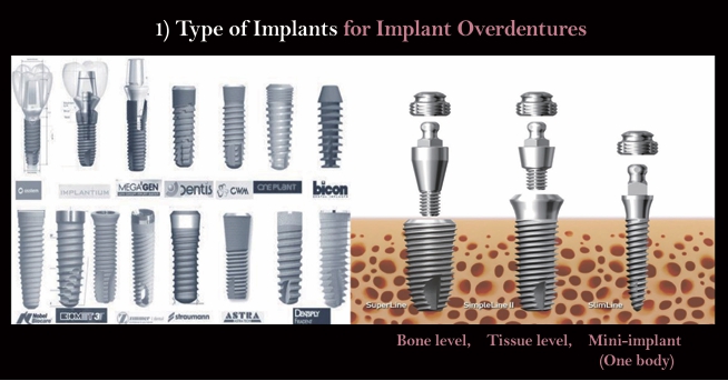 △ (그림 10) 임플란트의 종류. 다양한 형태의 임플란트가 있으며 bone level, Tissue level, One body implant 등을 들 수 있다.덴탈뉴스