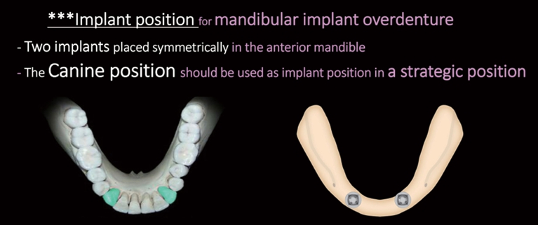 (그림 11) 2개의 임플란트를 식립할 경우 견치부위기 가장 선호되는 위치이다.덴탈뉴스