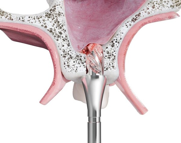                   디오임플란트가 새롭게 출시한 New Sinus Kit “Drill Solution” 덴탈뉴스