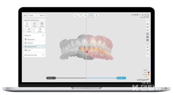 TRIOS 6 AI 진단 화면 사진출처: 3Shape Partner Portal. 덴탈뉴스