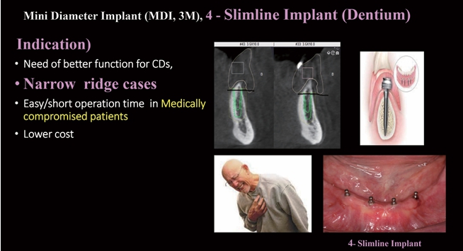 △ (그림 12) 치조골의 협설폭이 좁은 경우에는 Mini-diameter implant를 선택하게 되는데 이런 경우에는 4 개의 Mini implant를 식립하는 것이 좋다.