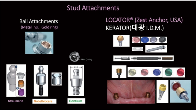 △ (그림 13a) 다양한 형태의 Stud attachment. Ball & Ring(Straumann), Mini ball(Dentium), LOCATOR(Zest Anchor), KERATOR(대광)