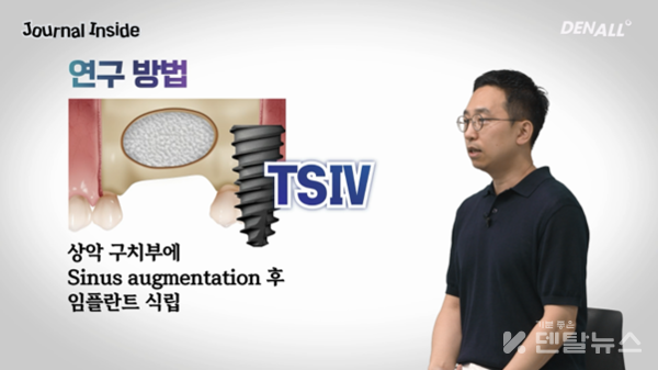 이중석 교수의 저널인사이드/Soft bone에 상악동 거상술 후 TSⅣ 임플란트 식립, 1.5년 임상 결과.  덴탈뉴스