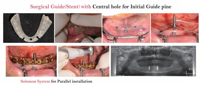 (그림 19) 예전에는 Fixture간의 평행하게 심는데 도움이 되는 장치로 SurgiGuide의 중앙에 Guide pin을 꽂을 수 있는 hole을 형성해주어 이용하면 편리하게 이용할 수 있었고, Solomon System을 이용하기도 하였다.