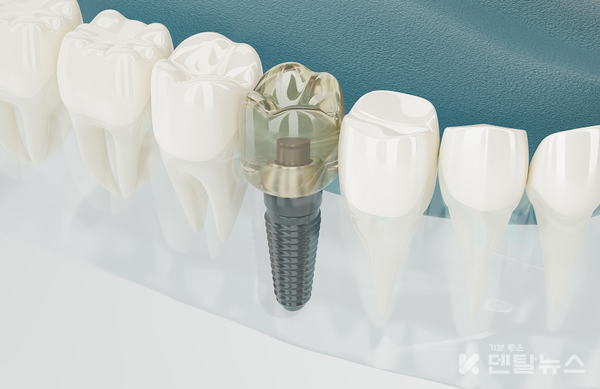 덴탈릭스는 exocad, 3Shape, Dental Wings 등 주요 보철 설계 프로그램(CAD)과 호환되는 임플란트 라이브러리 파일을 제공한다. 덴탈뉴스