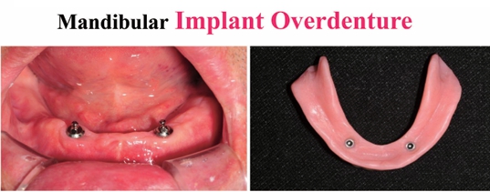 △ (그림 23) Denture에 attachment를 연결해주는 방법 및 완성된 Implant Overdenture.