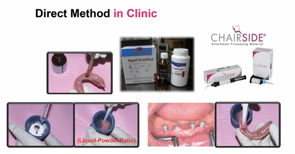 △ (그림 25) 직접법에 이용하는 재료는 Chair side(Attachment International), Self curing Acrylic resin, Super Bond(Sun Medical) 등이 이용될 수 있다.