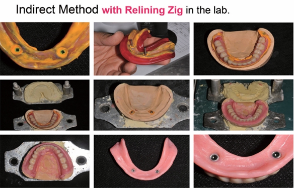 △ (그림 26) 인상 채득에 의한 기공실에서 연결해주는 간접법 (Indirect Method). Denture의 relining과 Attachment의 연결을 동시에 하는 경우 Relining Jig의 사용과 Self curing resin의 사용이 추천된다.