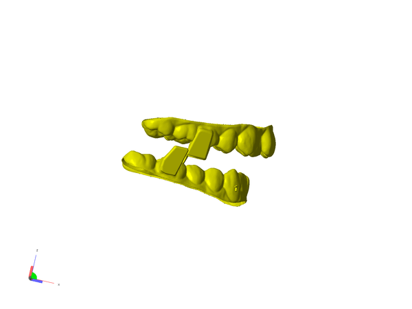 이번에 3D 프린팅 테크놀로지를 이용 bite wing 타입으로 디자인 제작함으로써 정확하고도 견고하게 턱위치를 잡아줄 수 있게 되었다. 덴탈뉴스